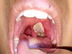 Ảnh bệnh lậu - 1