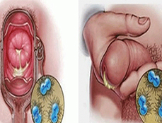 Ảnh bệnh lậu - 5